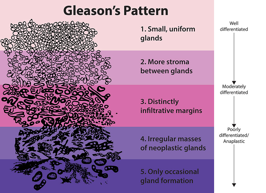 gleason score shows different patterns of cells and how they are ranked when determining the severity of prostate cancer