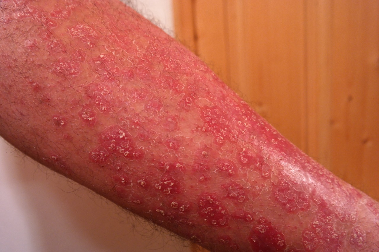 psoriasis on arm