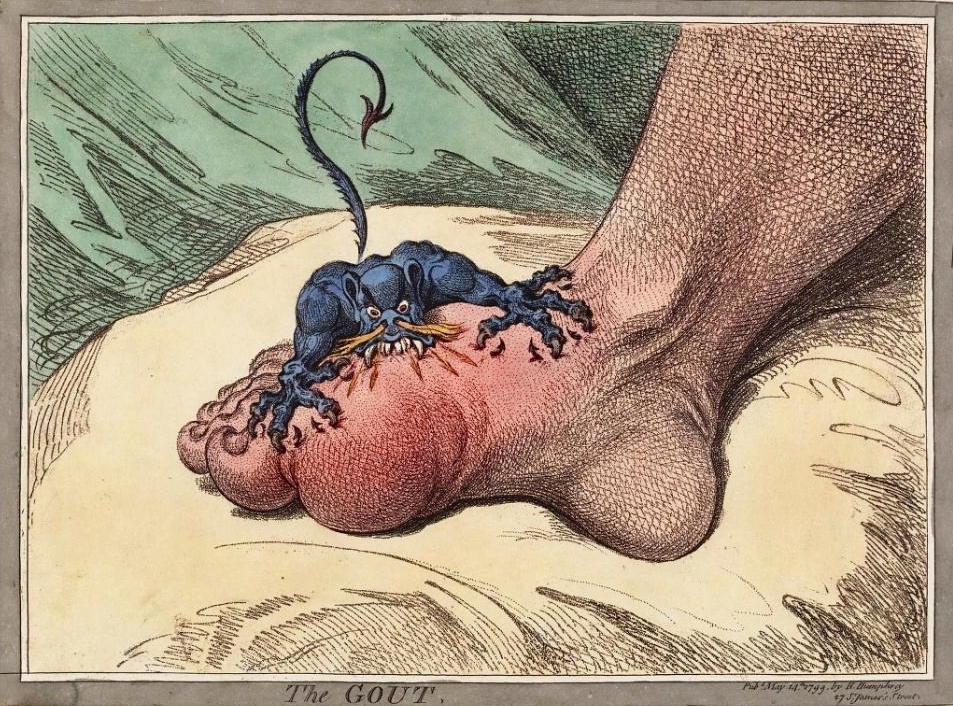 In 1799, artist James GIllray depicts gout as a small fierce creature with sharp teeth is biting into a swollen foot at the base of the big toe