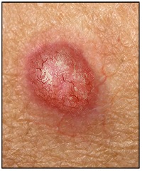 basal cell carcinoma