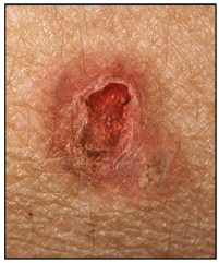 squamous cell carcinoma