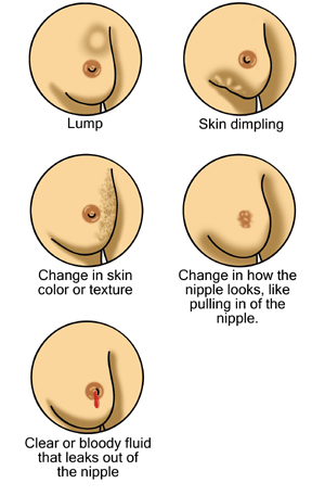 breast cancer signs