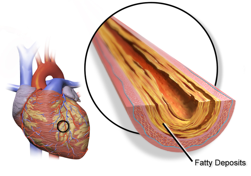 plaque building in coronary artery