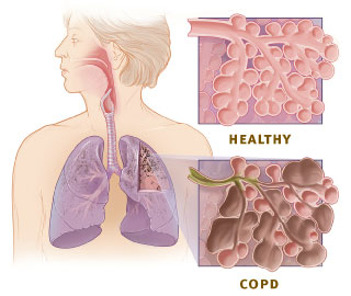 COPD lung compared to healthy lung