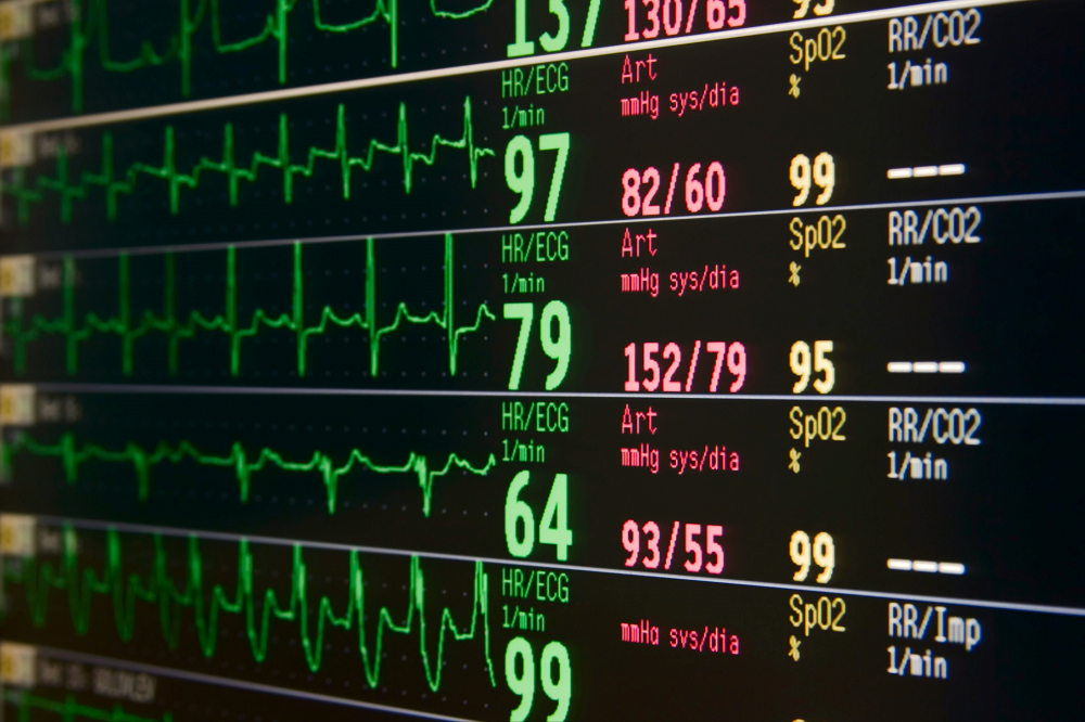 multiple ecgs in an icu